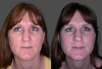 Skin Cancer Before & After Gallery - Patient 225341 - Image 1