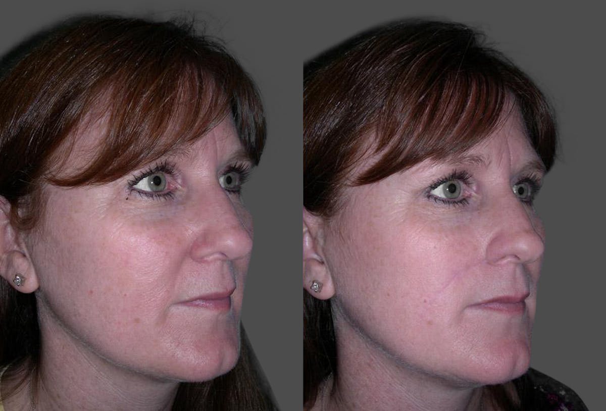 Skin Cancer Before & After Gallery - Patient 225341 - Image 2