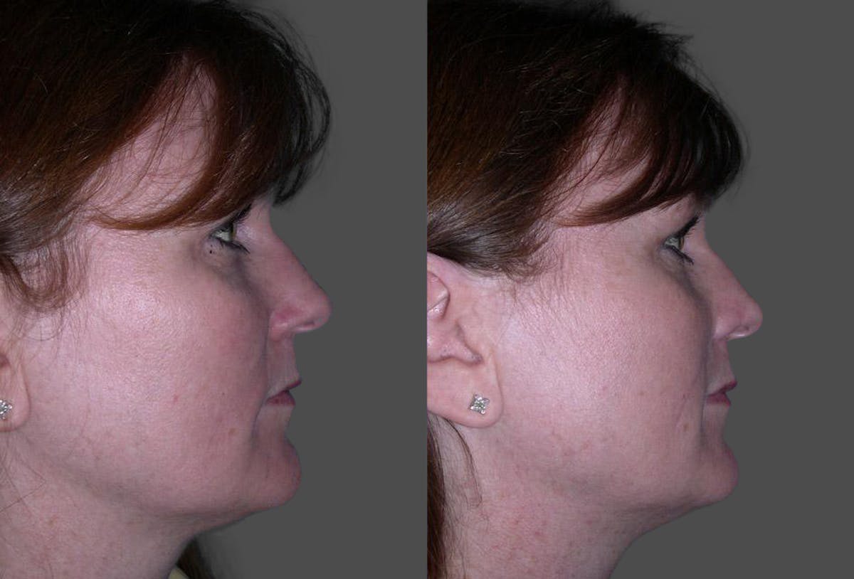 Skin Cancer Before & After Gallery - Patient 225341 - Image 3