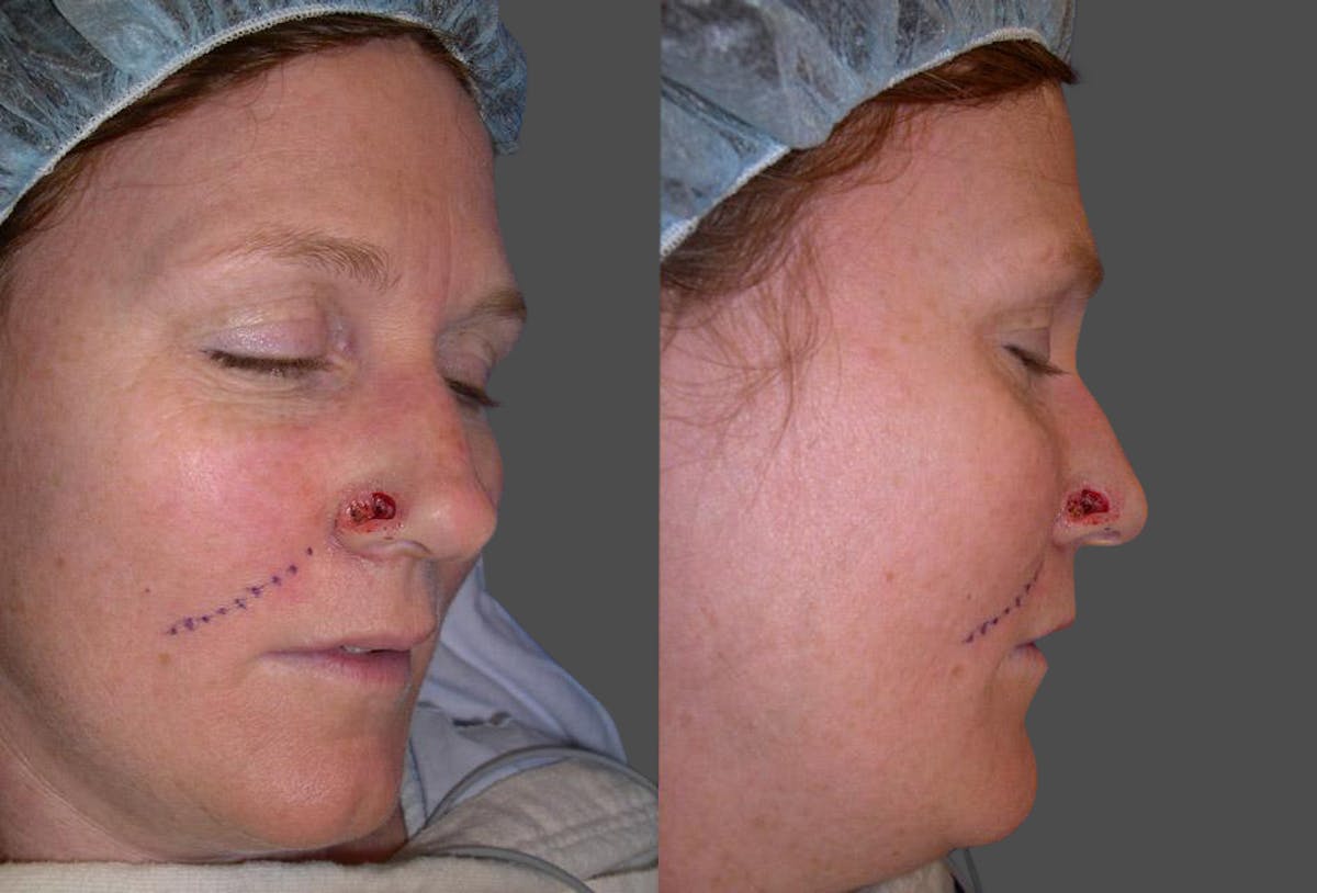 Skin Cancer Before & After Gallery - Patient 225341 - Image 4