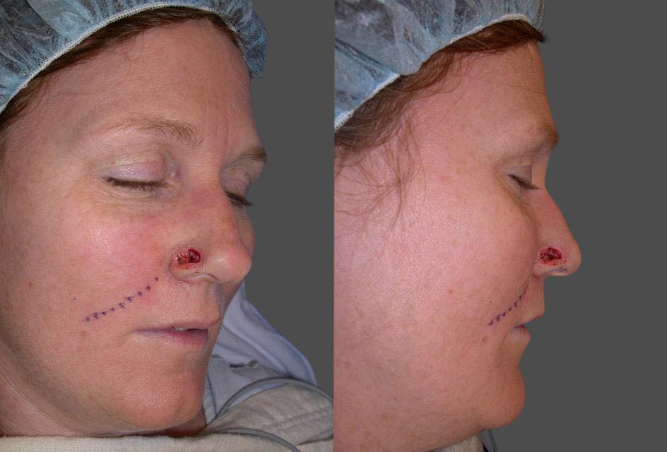 Skin Cancer Before & After Gallery - Patient 225341 - Image 4