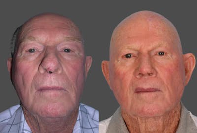 Skin Cancer Before & After Gallery - Patient 198091 - Image 1