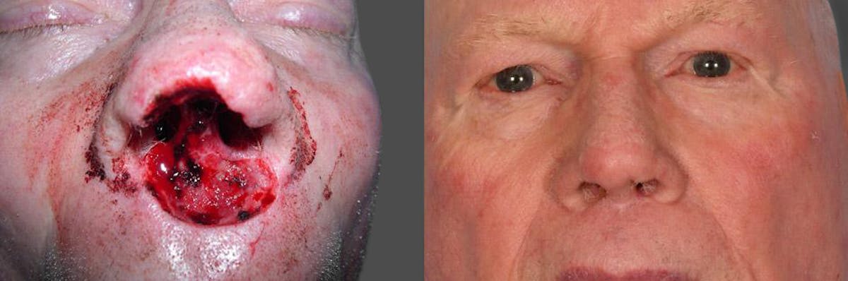 Skin Cancer Before & After Gallery - Patient 198091 - Image 2
