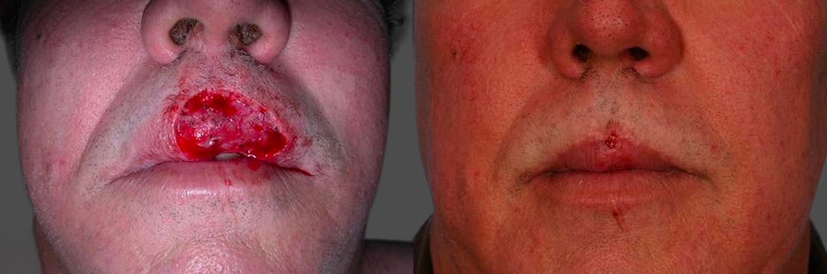 Skin Cancer Before & After Gallery - Patient 173970 - Image 1