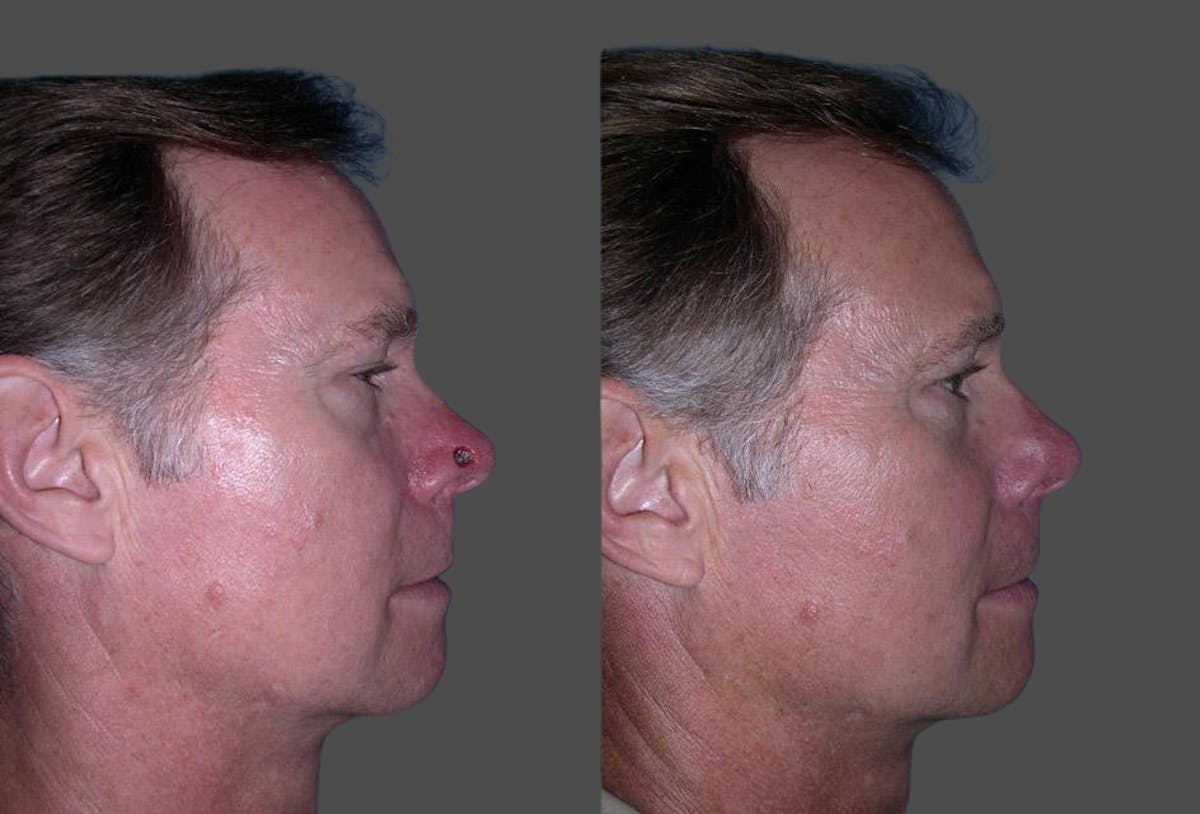 Skin Cancer Before & After Gallery - Patient 716863 - Image 3
