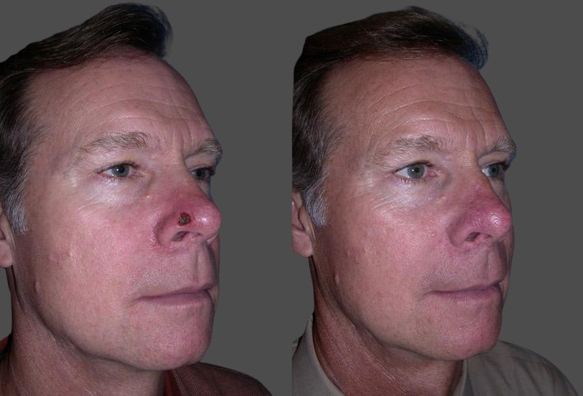 Skin Cancer Before & After Gallery - Patient 716863 - Image 2