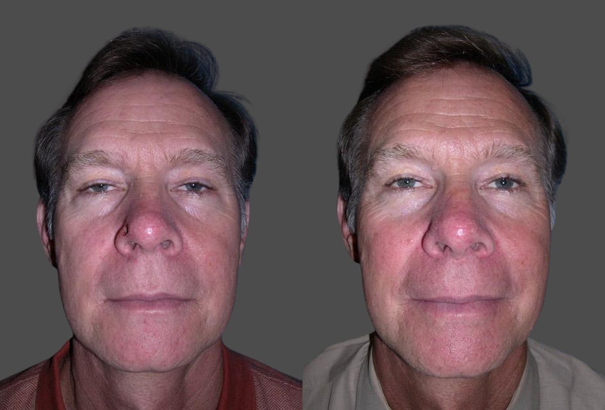 Skin Cancer Before & After Gallery - Patient 716863 - Image 1