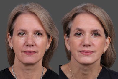 Facelift Before & After Gallery - Patient 411394 - Image 1