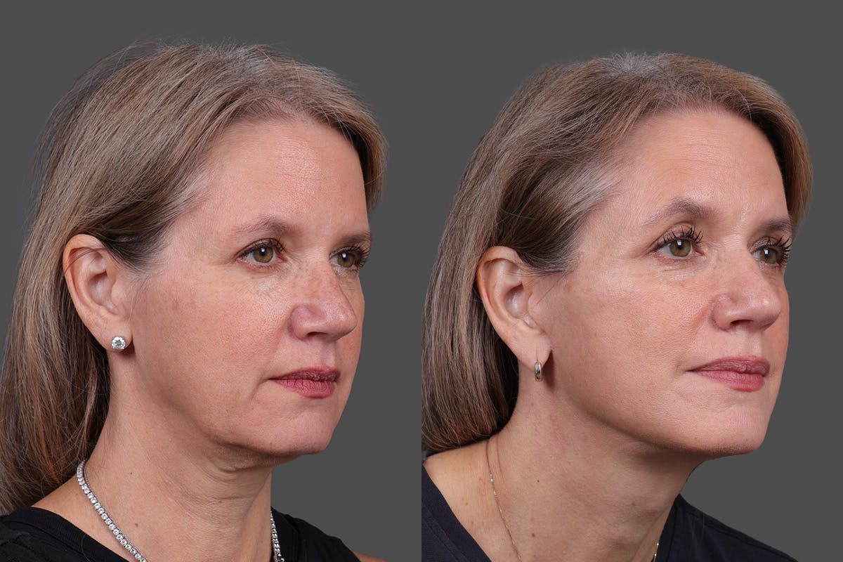 Facelift Before & After Gallery - Patient 411394 - Image 2