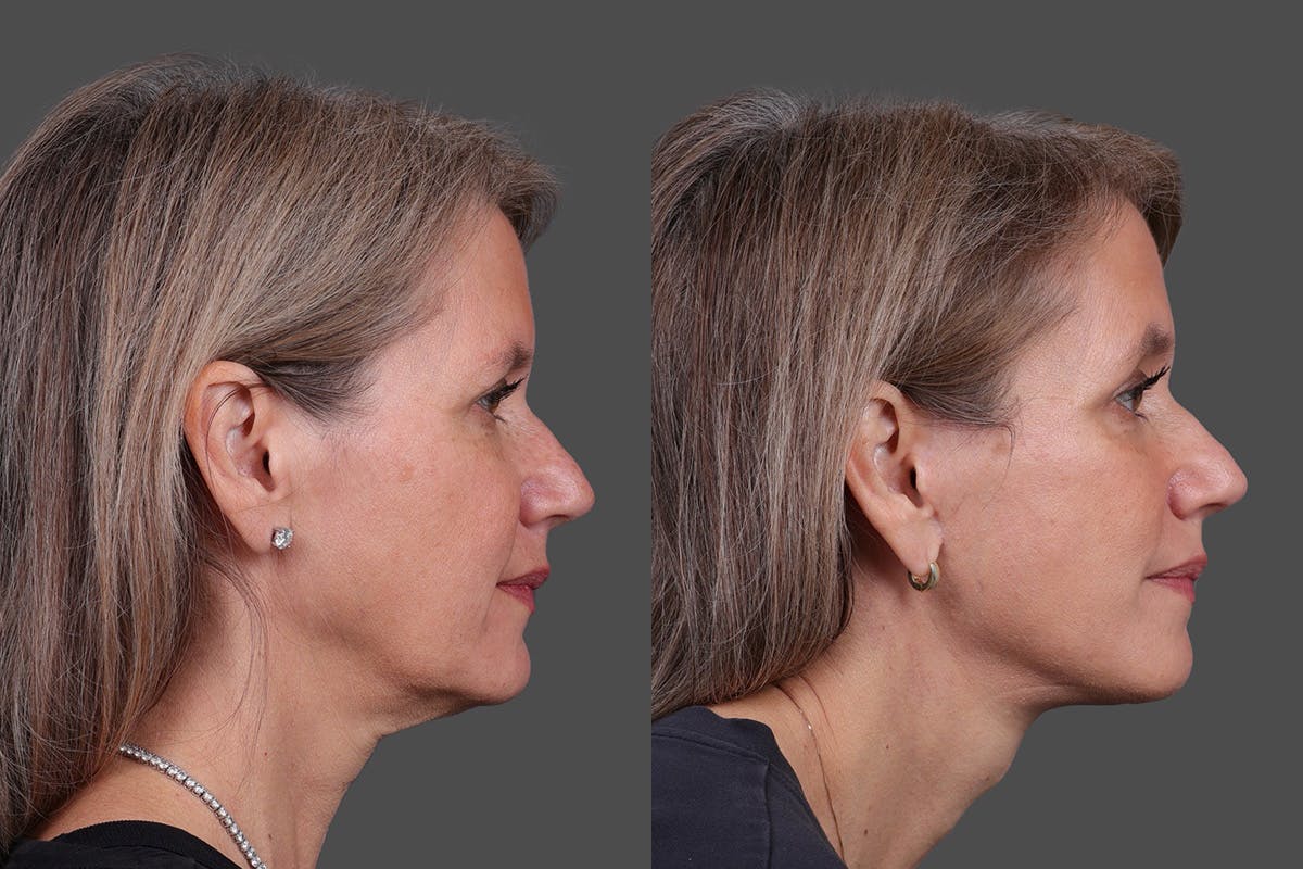 Facelift Before & After Gallery - Patient 411394 - Image 3