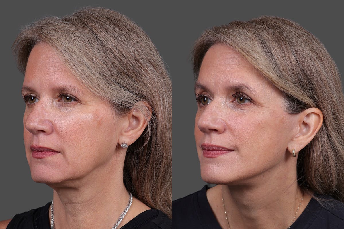 Facelift Before & After Gallery - Patient 411394 - Image 4