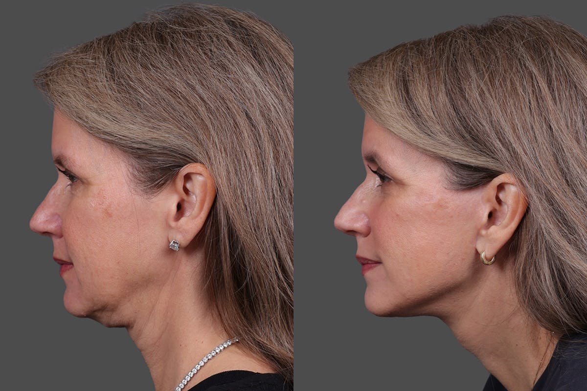 Facelift Before & After Gallery - Patient 411394 - Image 5