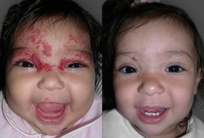 Birthmarks Before & After Gallery - Patient 406962 - Image 1