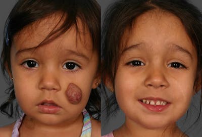 Birthmarks Before & After Gallery - Patient 187051 - Image 1