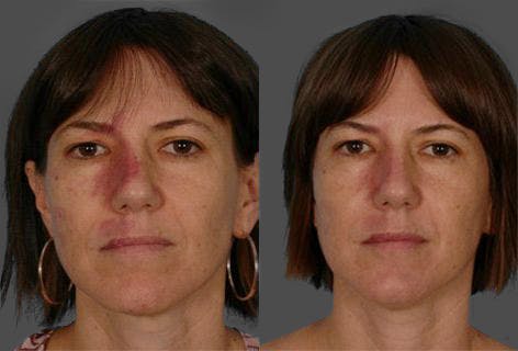Birthmarks Before & After Gallery - Patient 357184 - Image 1