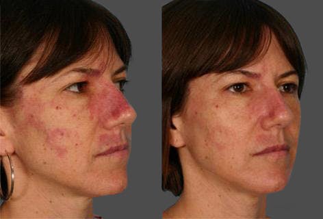 Birthmarks Before & After Gallery - Patient 357184 - Image 2