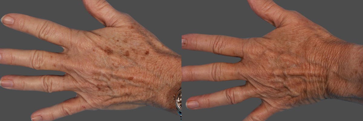Lasers Before & After Gallery - Patient 401193 - Image 1