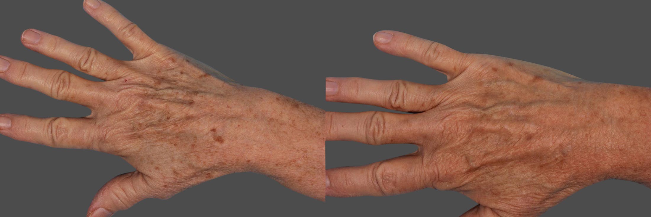 Lasers Before & After Gallery - Patient 401193 - Image 2