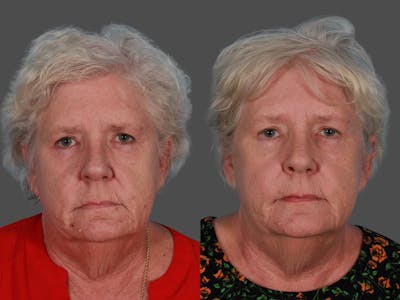 Lasers Before & After Gallery - Patient 326154 - Image 1