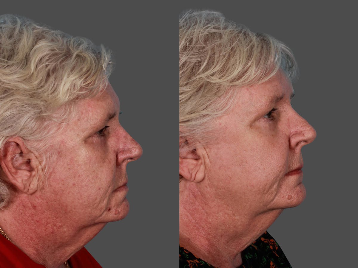 Lasers Before & After Gallery - Patient 326154 - Image 2