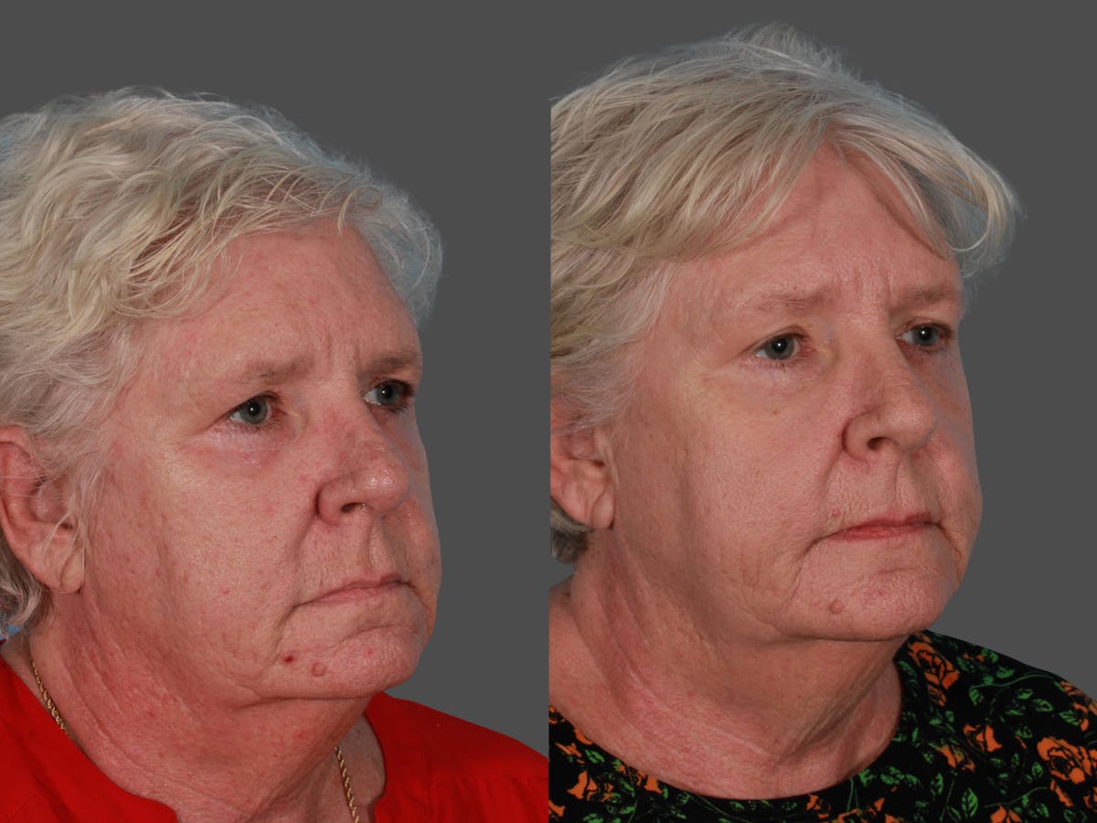 Lasers Before & After Gallery - Patient 326154 - Image 3