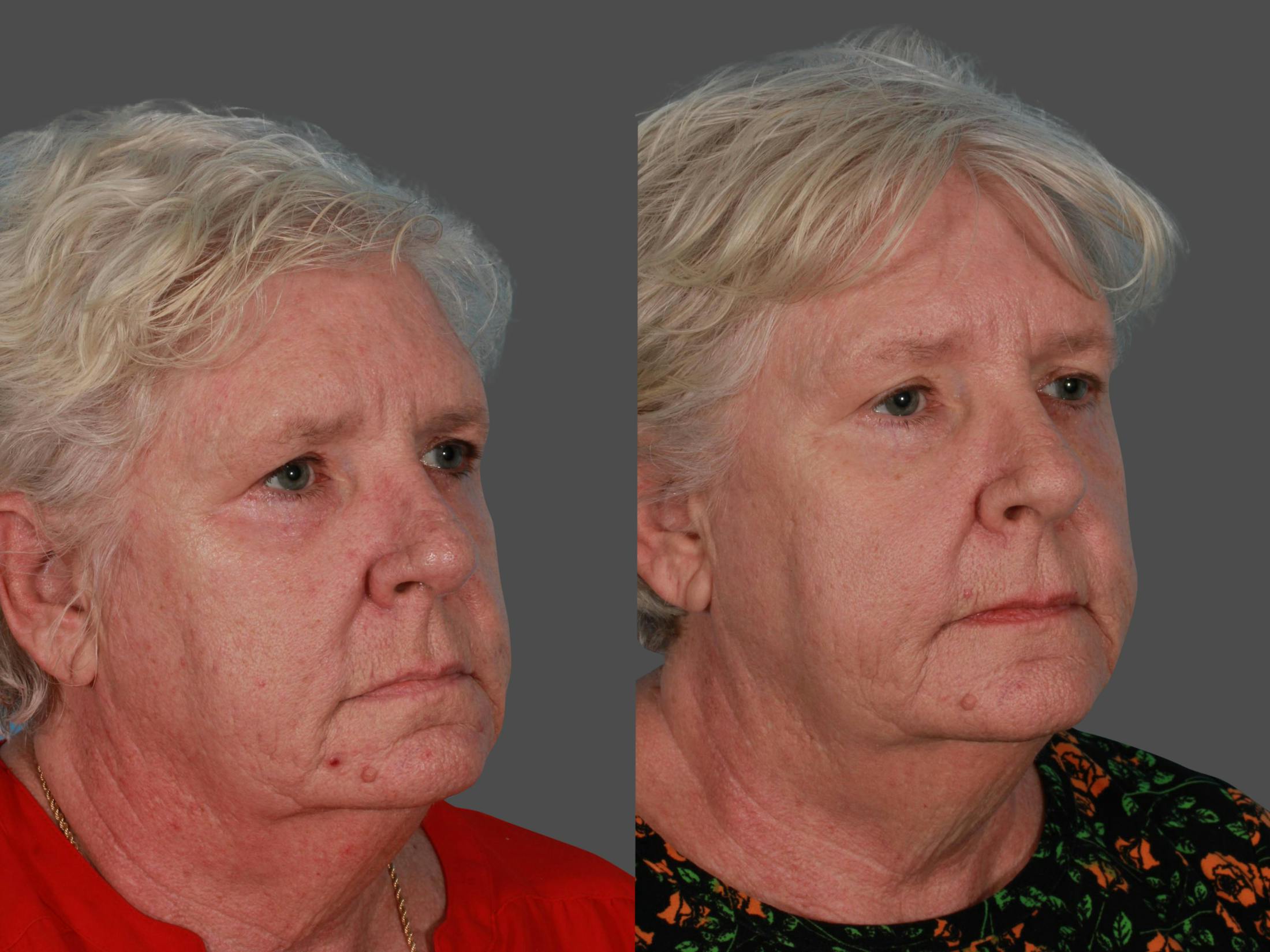 Lasers Before & After Gallery - Patient 326154 - Image 3