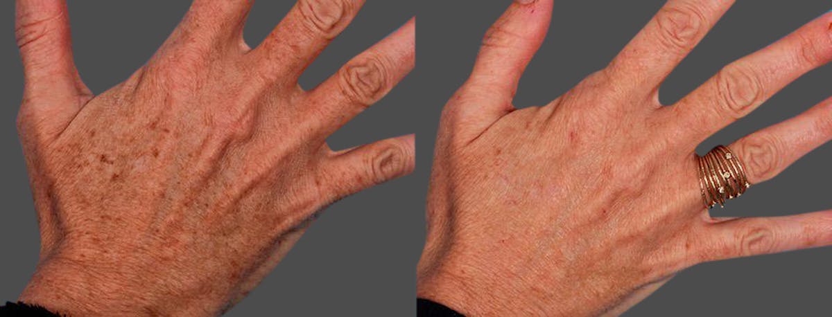 Lasers Before & After Gallery - Patient 316419 - Image 1