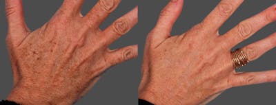 Lasers Before & After Gallery - Patient 316419 - Image 1