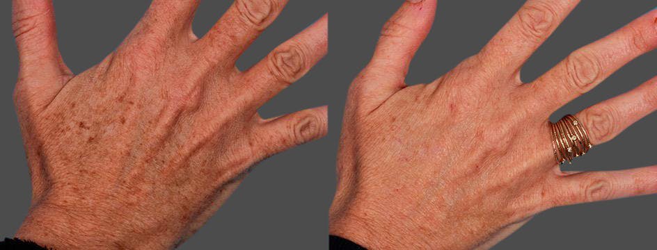 Lasers Before & After Gallery - Patient 316419 - Image 1