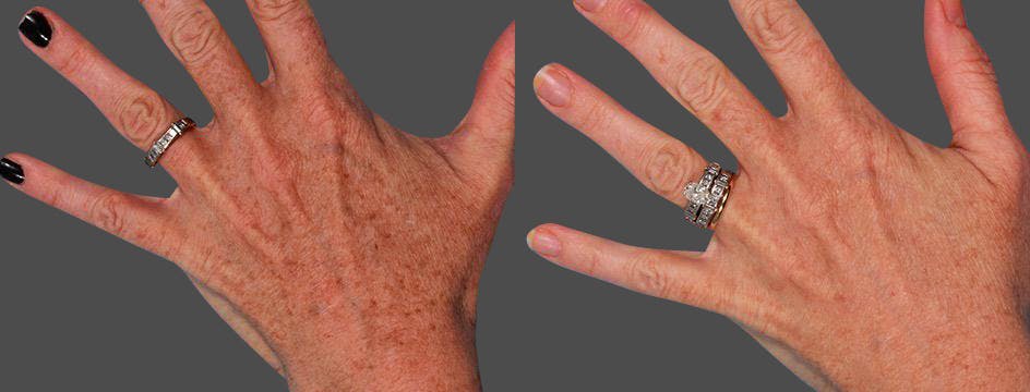 Lasers Before & After Gallery - Patient 316419 - Image 2