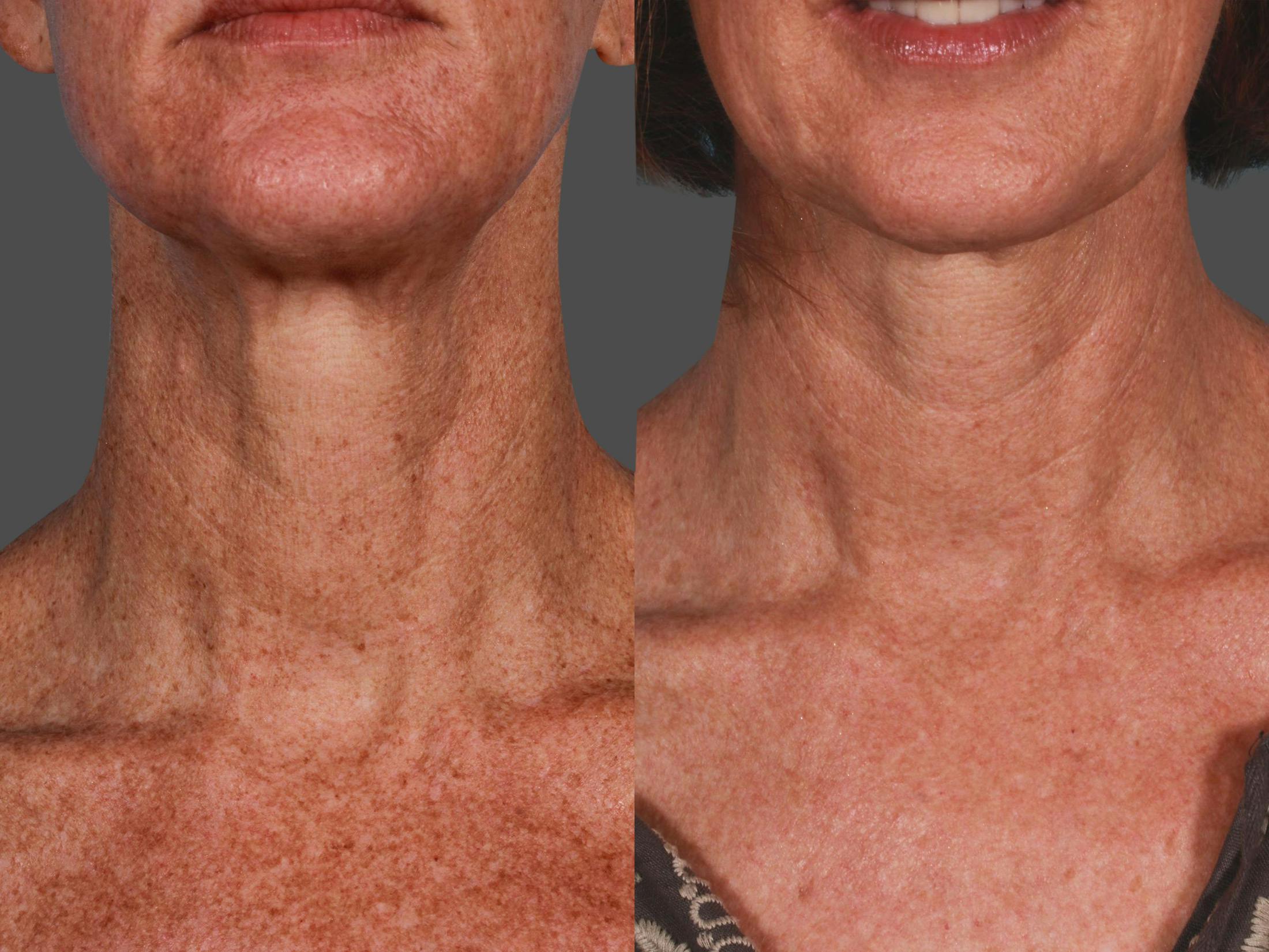 Lasers Before & After Gallery - Patient 125257 - Image 1