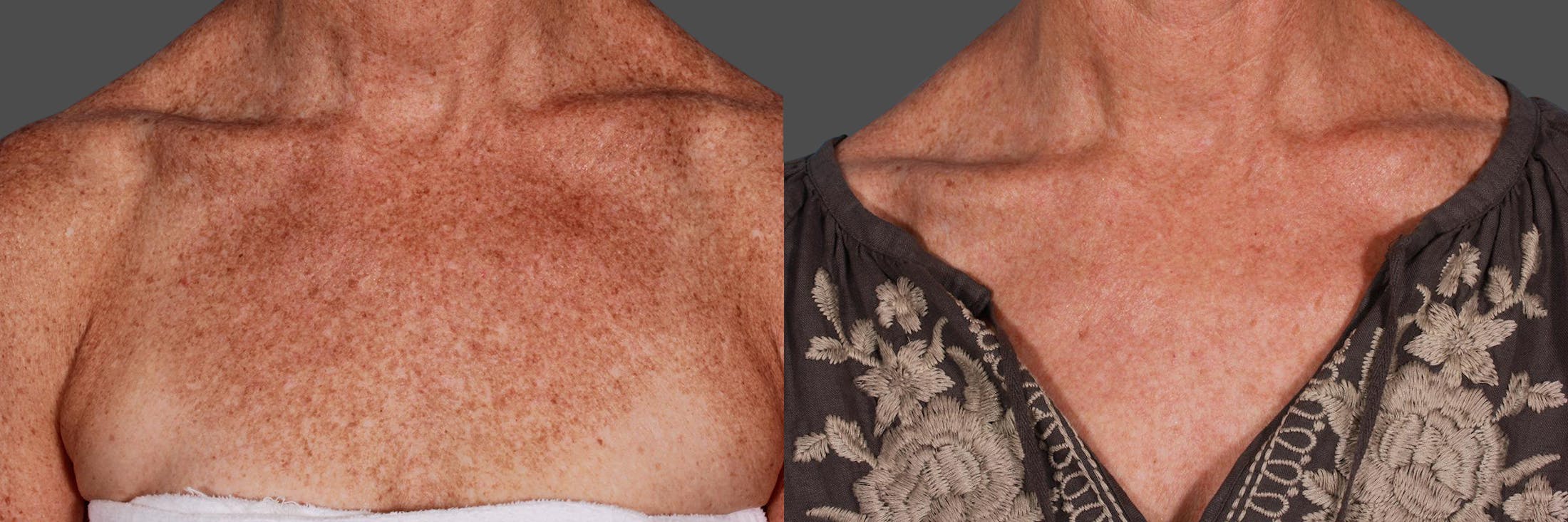 Lasers Before & After Gallery - Patient 125257 - Image 2