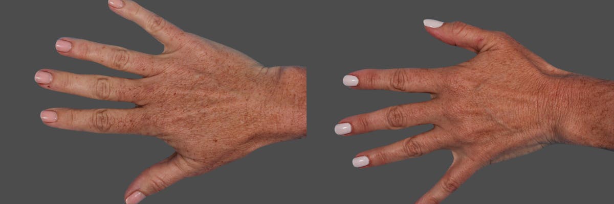 Lasers Before & After Gallery - Patient 125257 - Image 3