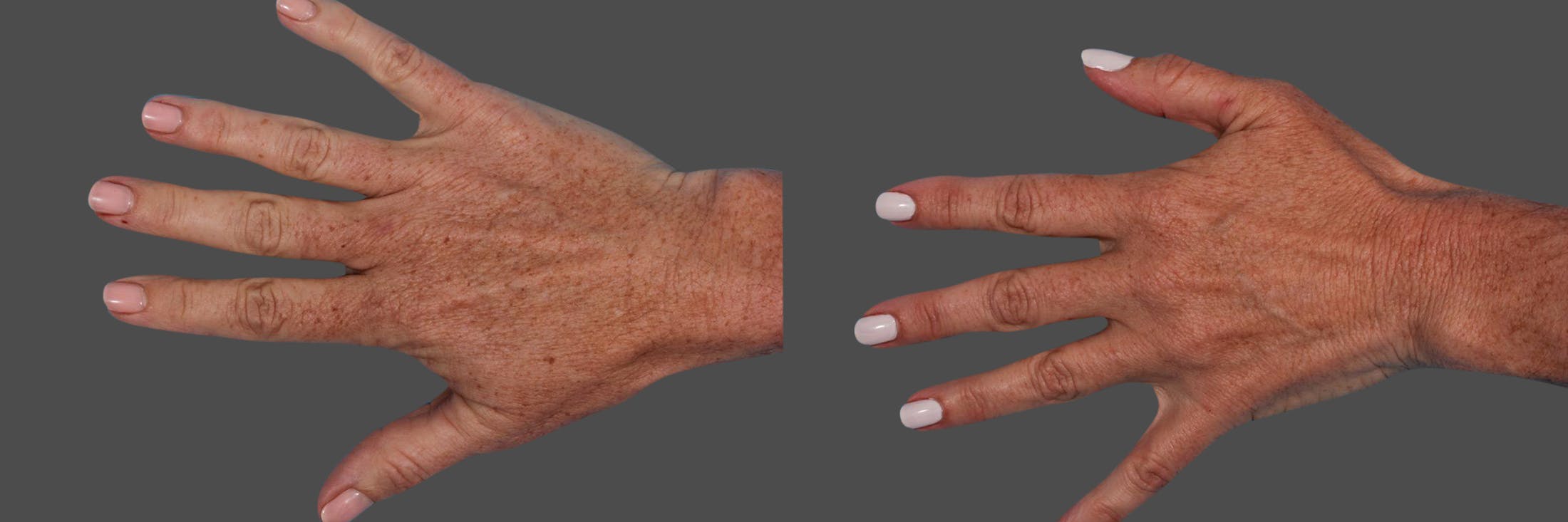 Lasers Before & After Gallery - Patient 125257 - Image 3