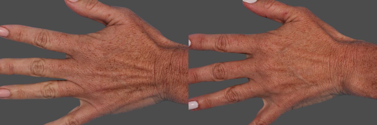 Lasers Before & After Gallery - Patient 125257 - Image 4