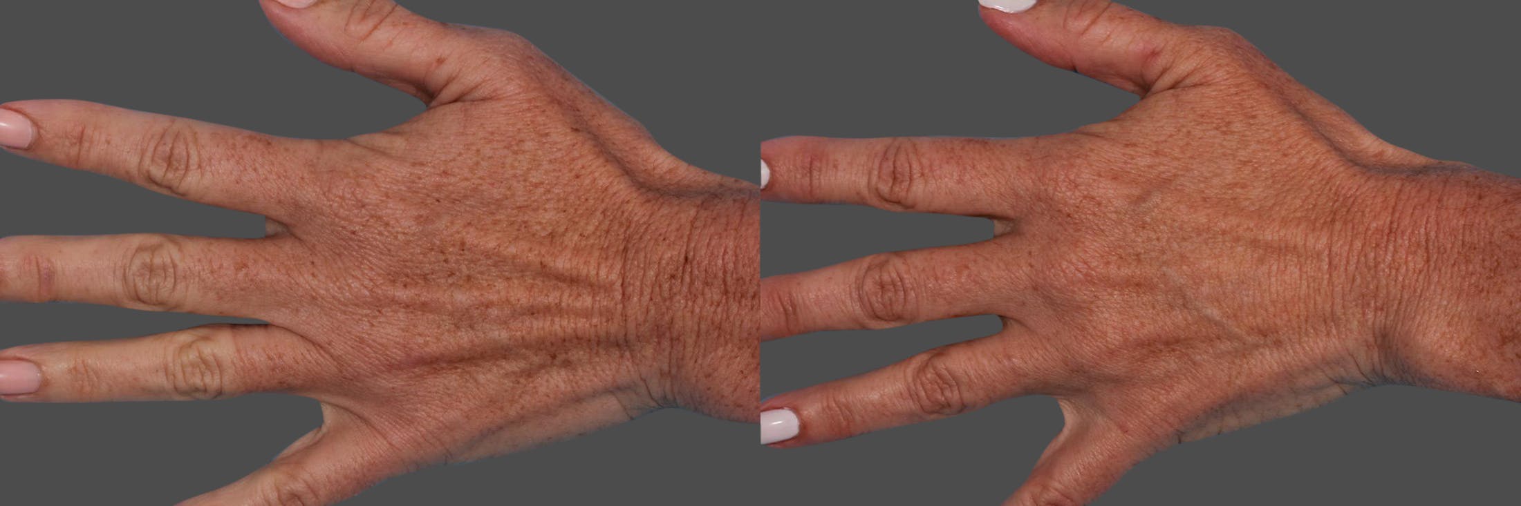 Lasers Before & After Gallery - Patient 125257 - Image 4