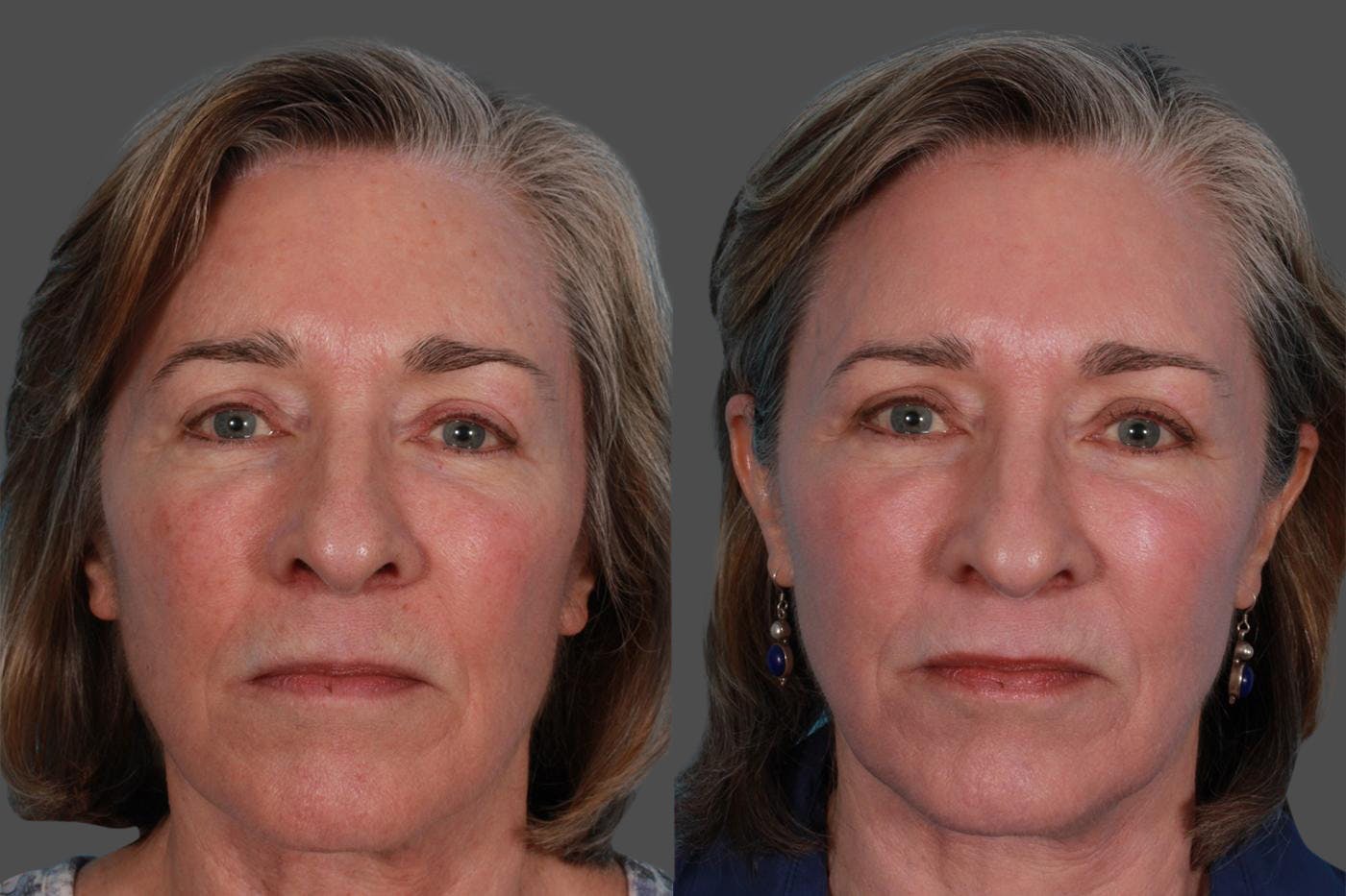 Lasers Before & After Gallery - Patient 116816 - Image 1