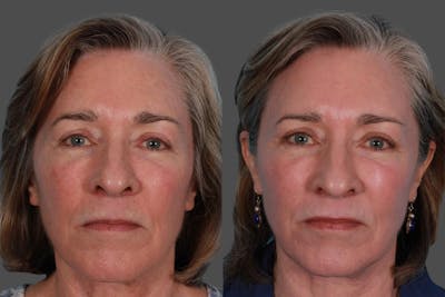 Lasers Before & After Gallery - Patient 116816 - Image 1