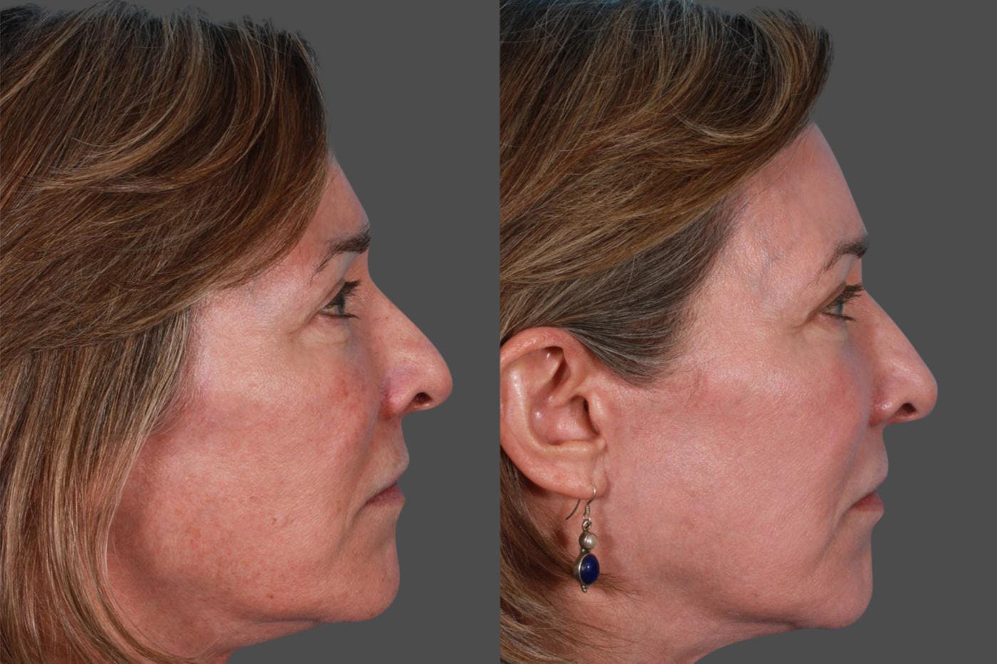 Lasers Before & After Gallery - Patient 116816 - Image 2