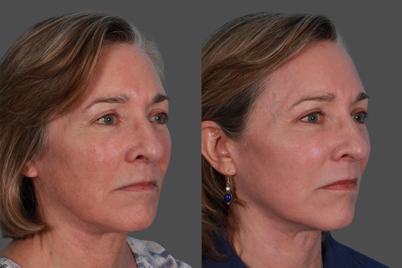 Lasers Before & After Gallery - Patient 116816 - Image 3