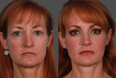 Restylane® Before & After Gallery - Patient 903628 - Image 1