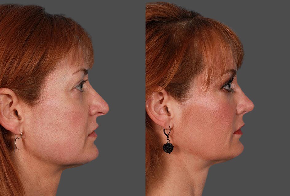 Restylane® Before & After Gallery - Patient 903628 - Image 2