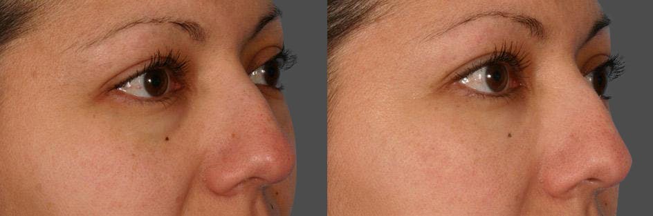 Restylane® Before & After Gallery - Patient 834933 - Image 2