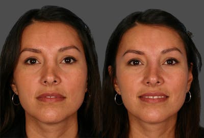 Restylane® Before & After Gallery - Patient 803261 - Image 1