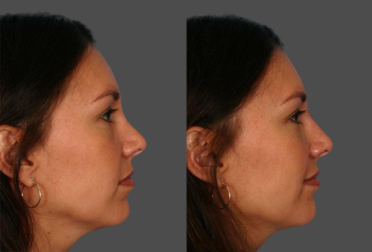 Restylane® Before & After Gallery - Patient 803261 - Image 2