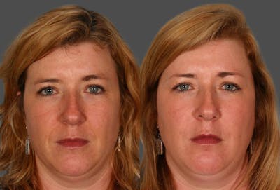 Restylane® Before & After Gallery - Patient 413575 - Image 1