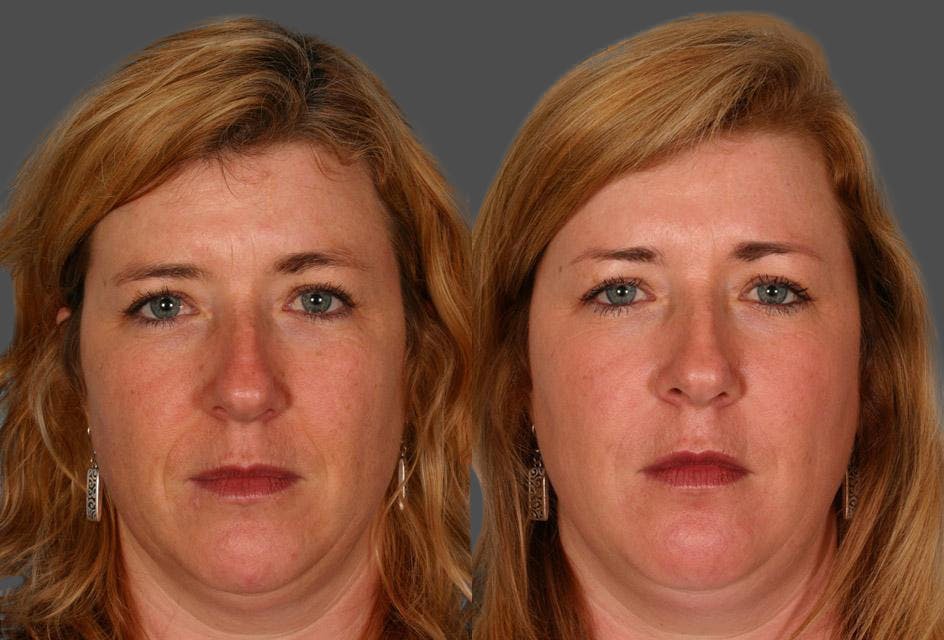 Restylane® Before & After Gallery - Patient 413575 - Image 1