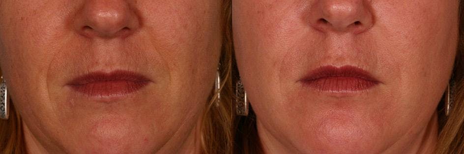 Restylane® Before & After Gallery - Patient 413575 - Image 2