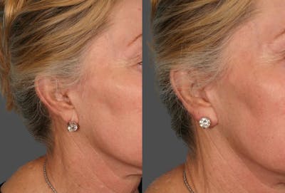 Restylane® Before & After Gallery - Patient 328348 - Image 1