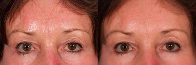 Restylane® Before & After Gallery - Patient 299285 - Image 1